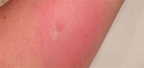 How long do bee stings stay swollen?