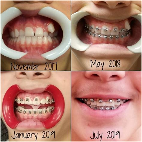 How long do braces last?