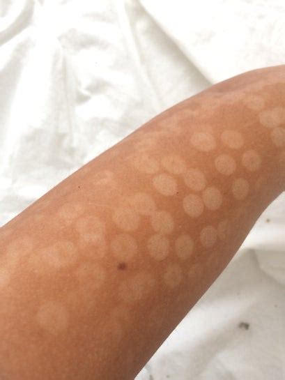 How long do brown burn marks last?