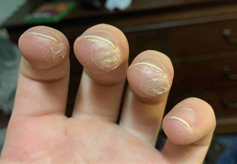 How long do calluses take to form?