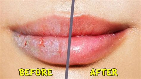How long do dry lips take to heal?
