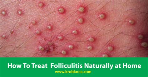 How long do folliculitis bumps last?
