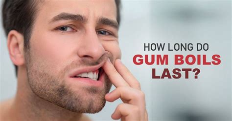How long do gum boils last?