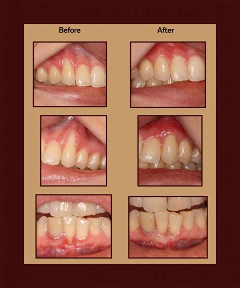 How long do gum grafts last?