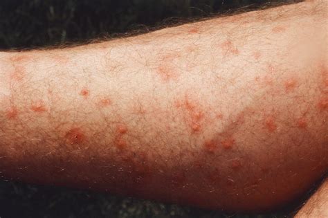 How long do mite bites last?