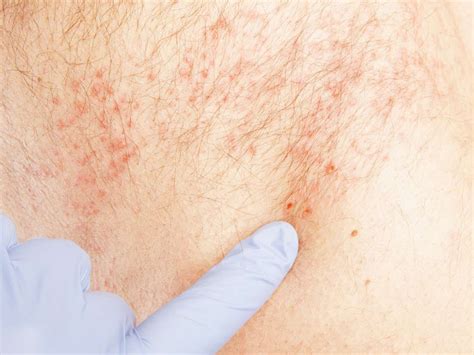 How long do rashes usually last?