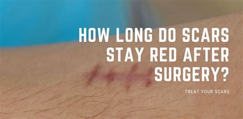 How long do scars stay red?