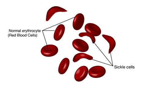 How long do sickle cells live?