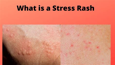 How long do stress rashes last?