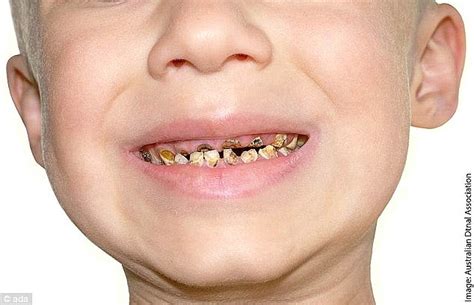 How long do teeth last without brushing?