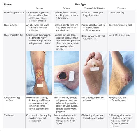 How long do ulcers last without treatment?