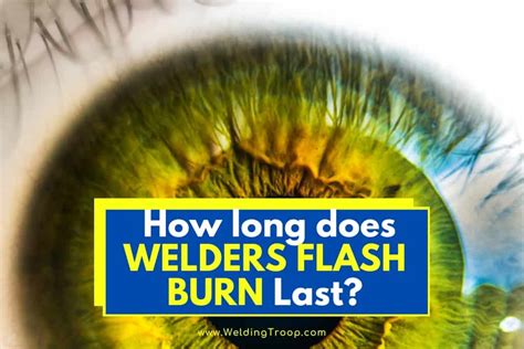 How long do welding burns last?
