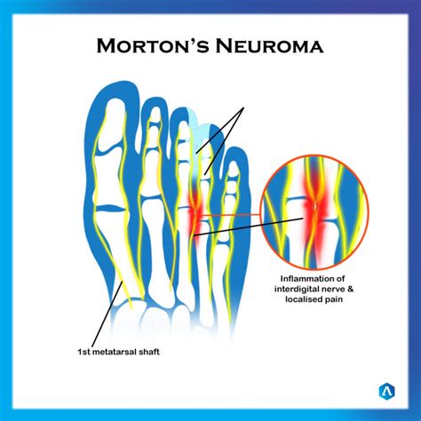 How long do you have to be off work for Morton's neuroma?