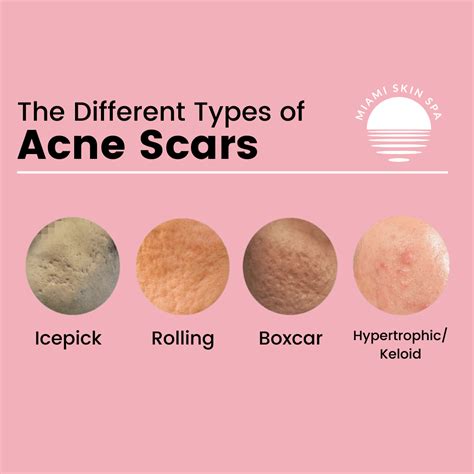 How long does Bacne scars last?