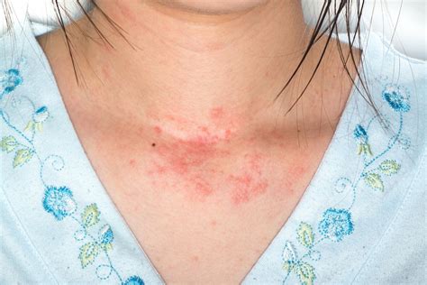 How long does a rash from skincare last?