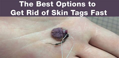 How long does a skin tag take to fall off with cotton?