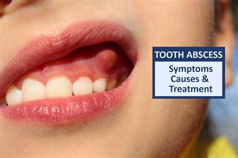 How long does a tooth abscess last with antibiotics?