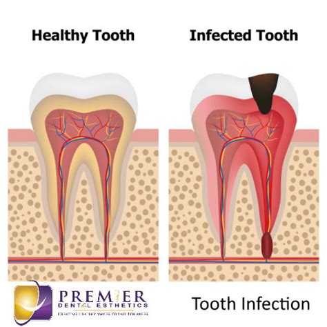 How long does a tooth infection last without antibiotics?