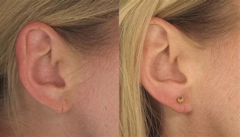 How long does a torn earlobe take to heal?