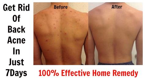 How long does back acne last?