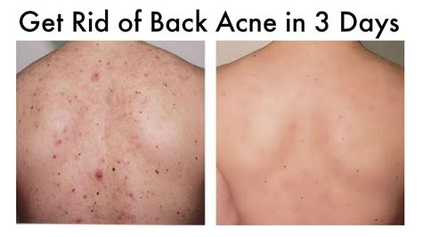 How long does back acne take to clear up?