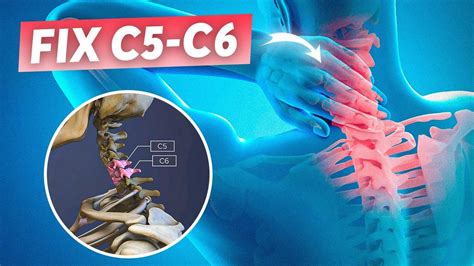 How long does c5 c6 take to heal?