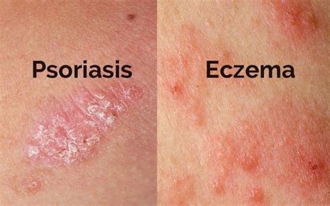 How long does eczema discoloration last?