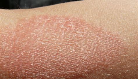 How long does eczema flaking last?
