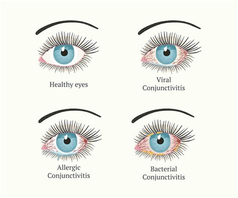 How long does eye bacteria last?