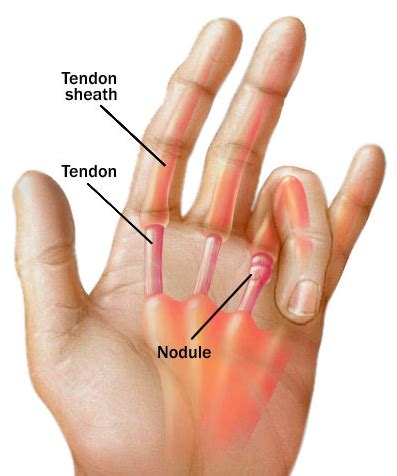 How long does finger stiffness last after surgery?