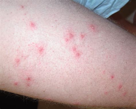 How long does folliculitis itch last?