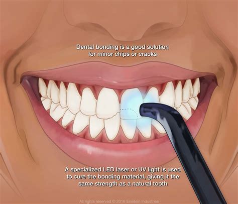 How long does glue last on teeth?