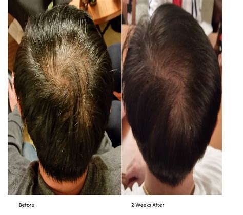 How long does hair thinning take?