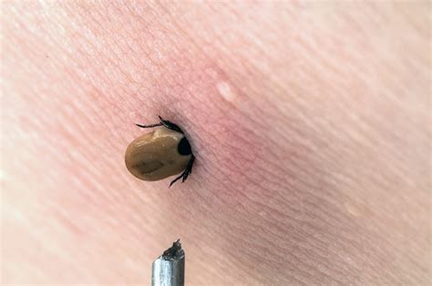 How long does it take a tick to burrow its head?