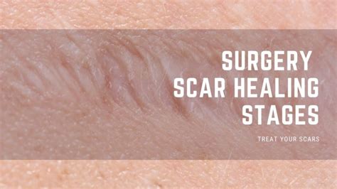 How long does it take a white scar to heal?