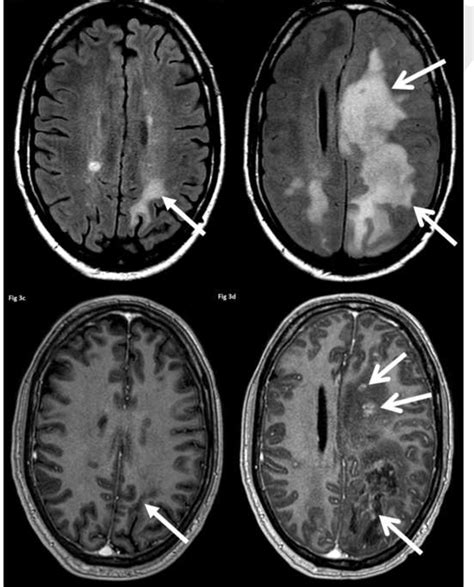 How long does it take for MS lesions to show on MRI?