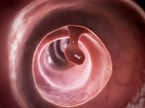 How long does it take for a 10 mm colon polyp to grow?