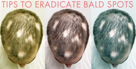 How long does it take for a bald spot to grow back?