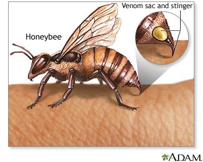 How long does it take for a bee sting to cause anaphylaxis?