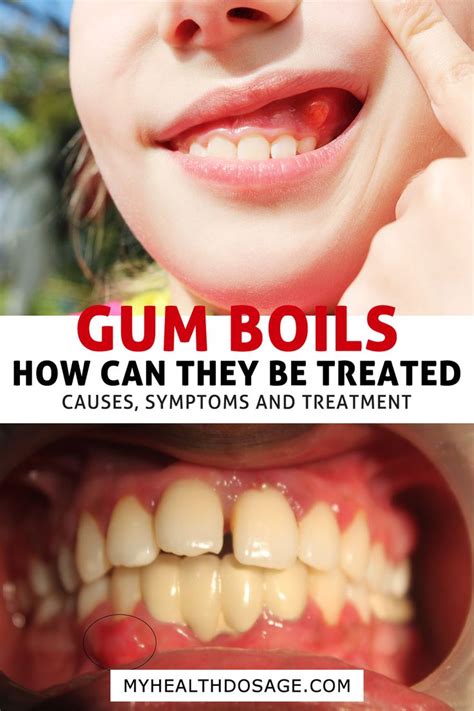 How long does it take for a gum cyst to go away?