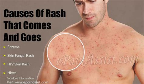 How long does it take for a rash to go away on its own?