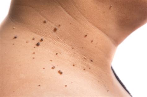 How long does it take for a skin tag to fall off?