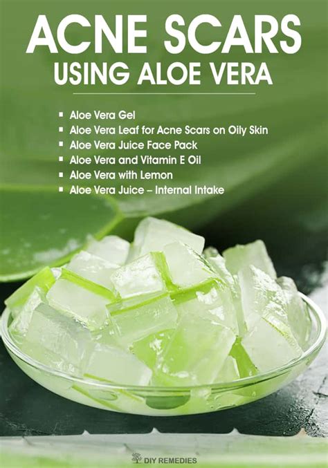 How long does it take for aloe to clear acne?