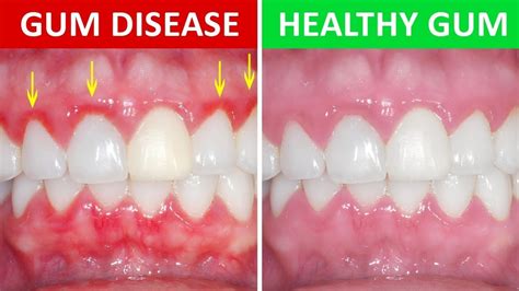 How long does it take for an infection in your gums to go away?