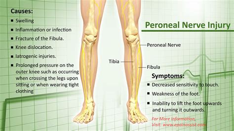 How long does it take for an irritated peroneal nerve to heal?