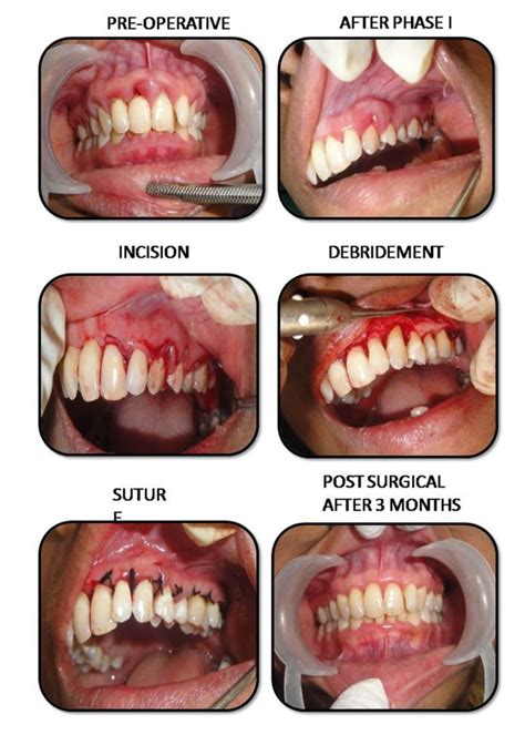 How long does it take for gums to completely heal?