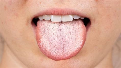 How long does it take for oral thrush to clear up?