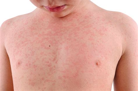 How long does it take for pad rash to go away?