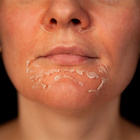 How long does it take for peeling skin to look normal?