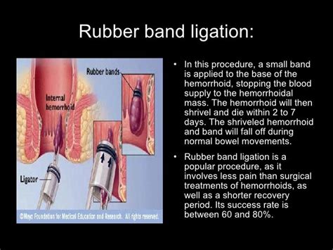 How long does it take for rubber band ligation to fall off?